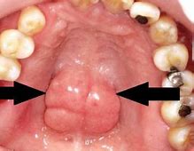 Kenapa Di Langit Langit Mulut Ada Benjolan Keras